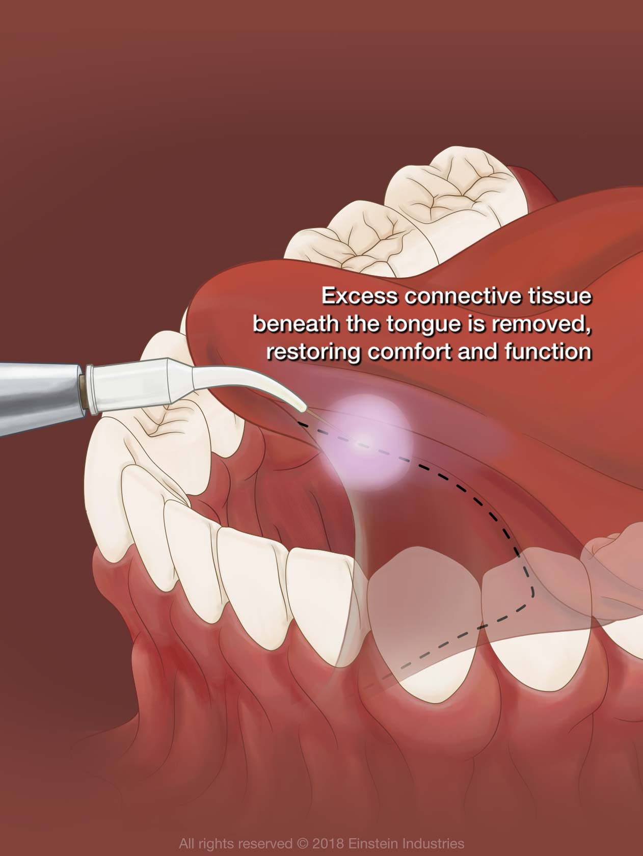 Illustration of frenectomy
